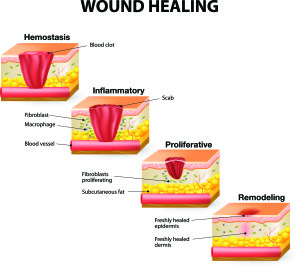 Stages of Healing_image