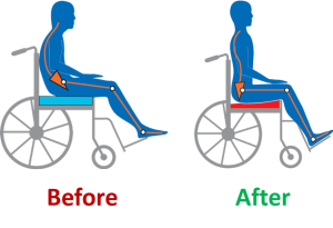 Use pressure redistribution cushions for correct fit -- and to prevent skin breakdown. Credit: AliMed