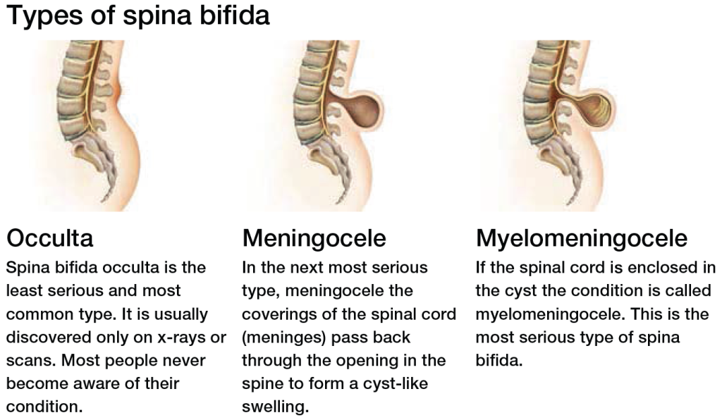 Diagnosis Focus Spina Bifida Shield Healthcare