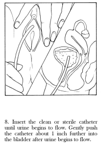 How to use an Intermittent Catheter 8