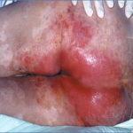 la dermatitis asociada a la incontinencia