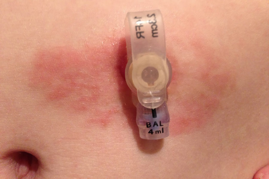 Cuidado de una sonda de alimentación gástrica