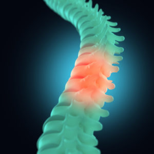 Spinal Cord Injury