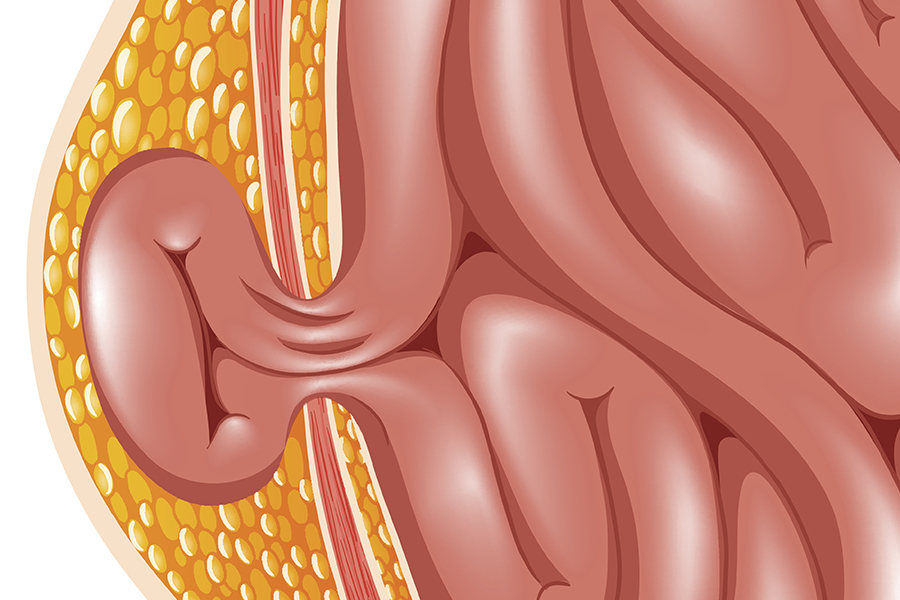 Peristomal Hernia