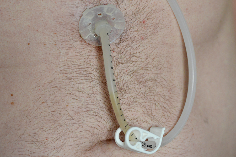 feeding tube