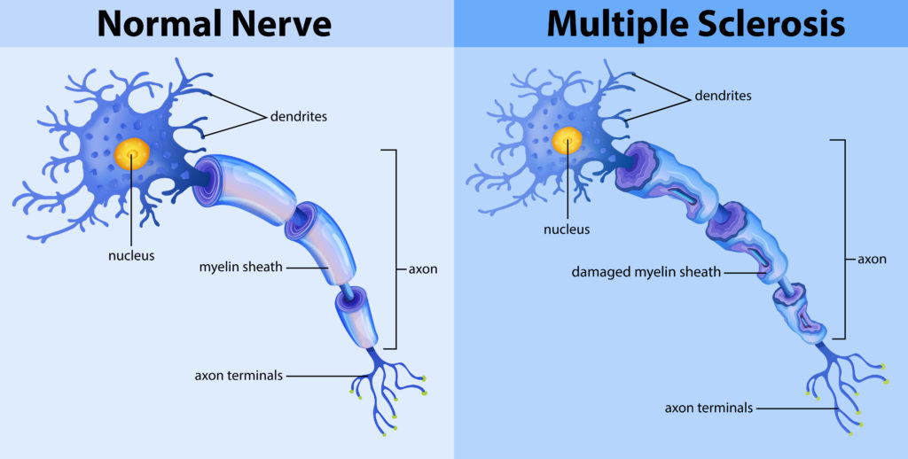 Multiple sclerosis