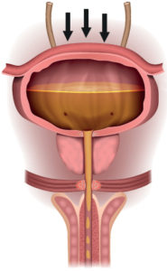 what is stress incontinence