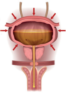 what is urge incontinence