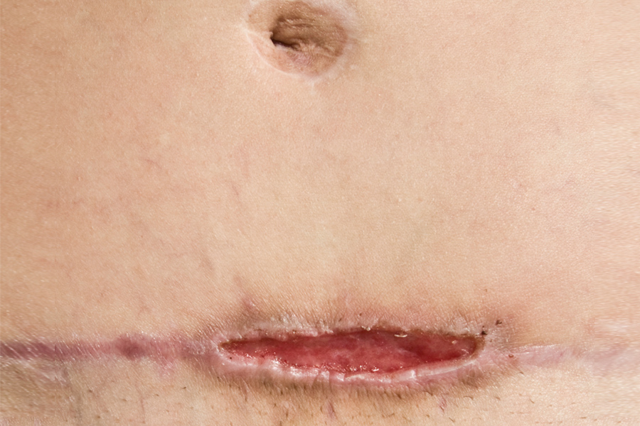 wound dehiscence. c surgery scar reopening or failing to heal