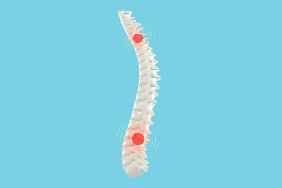 Spinal Cord Injury