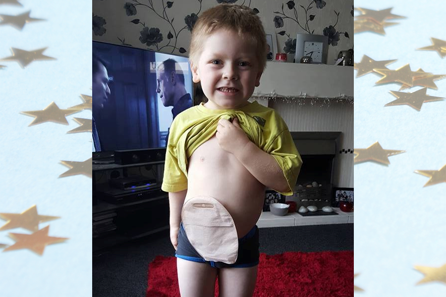 Boy Surprises Parents by Wearing Dad's Ostomy Bag