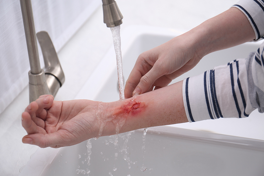 treating minor scrapes and burns