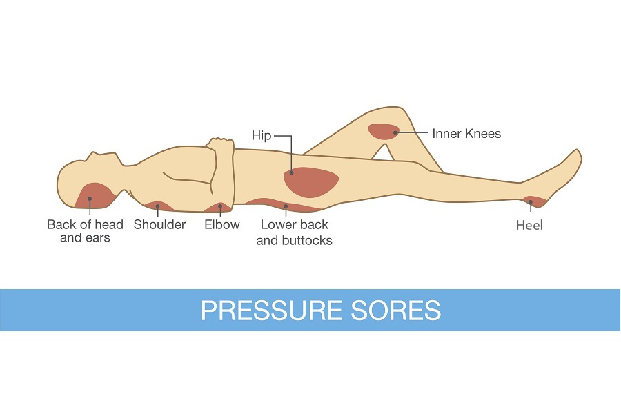 How to Prevent Pressure Sores After a Spinal Cord Injury