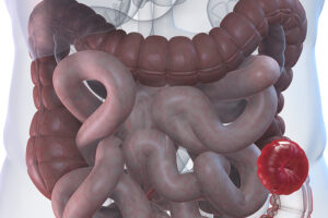 What is an Ostomy